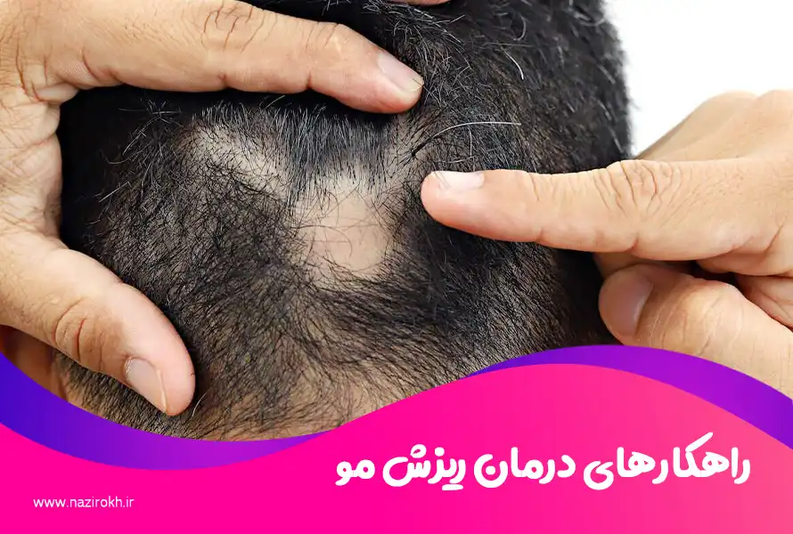 راهکارهای درمان ریزش مو